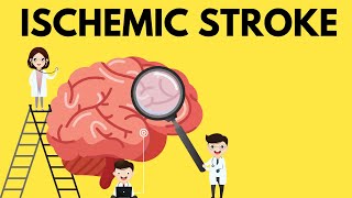 The Essential Guide to Ischemic Stroke [upl. by Yort]