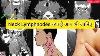 CT Scan Showing Neck Nodes गर्दन में गांठ के क्या कारण हैं।  nodes lymphoma Radiologydept [upl. by Airreis]