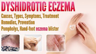 Dyshidrotic Eczema Causes Types Symptoms Treatment Remedies and Prevention  Pompholyx eczema [upl. by Nager]