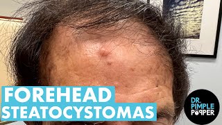 WHAT IS ON YOUR FOREHEAD Dr Pimple Popper Extracts Steatocystomas  Part 1 [upl. by Ardnoyek274]