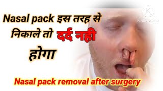 Nasal pack removal after septoplasty Nasal pack removal [upl. by Schweitzer]