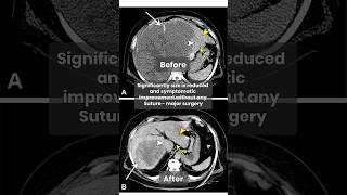 Liver Hemangioma Treatment Embolization Procedure Explained  Dr Amol Lahoti shortsfeed2024 [upl. by Maurer]