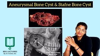 Aneurysmal Bone Cyst  Stafne Bone Cyst  Lecture 18  Oral Pathology [upl. by O'Conner563]