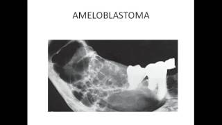 Maxillofacial radiology  MULTILOCULAR RADIOLUCENCY OF JAW [upl. by Sandye]