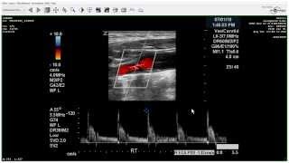 Carotid Duplex Total Occlusion  Case Study [upl. by Hait856]