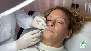 Dimostrazione Filler Labbra  drssa Francesca Palumbo [upl. by Htenay202]