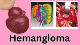 Liver Hemangioma Causes Symptoms Diagnosis amp Treatment [upl. by Anoo161]