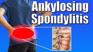 Managing Ankylosing Spondylitis Top Exercises amp Tips for Relief [upl. by Ordnasela]