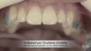 Orthodontie Invisible Strasbourg  Traitement par Gouttières  Dr Eric URSAT [upl. by Onia]