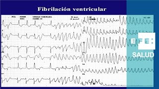 Taquicardia La fibrilación ventricular caos y shock [upl. by Lleznov44]