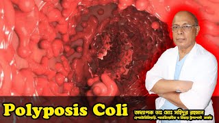 Polyposis Coli । কোলনে অসংখ্য পলিপ । অধ্যাপক ডাঃ মোঃ সহিদুর রহমান।LGSH [upl. by Anaitsirk]