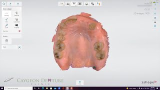 Intraoral Scans for Cast Partial Upper Denture [upl. by Ydnahs]