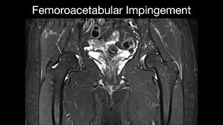 Femoroacetabular Impingement [upl. by Ada]