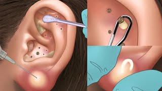 ASMR Animation Remove The Big Pus From The Ear Treatment animation satisfying asmr [upl. by Muscolo]