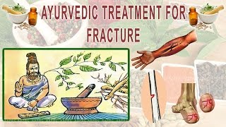 Ayurvedictreatmentforfracture AdvanceAyurveda Ayurvedic Treatment for Fracture  Advance Ayurveda [upl. by Lienet190]