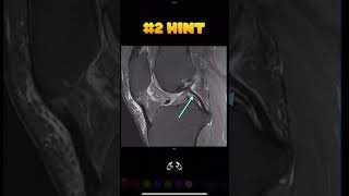 Fig 1A11 Meniscofemoral ligaments Humphrey ligament [upl. by Berkow]