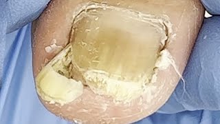 Obvious lesions of toenails treatment of onychomycosis【Xue Yidao】 [upl. by Enitsenrae]