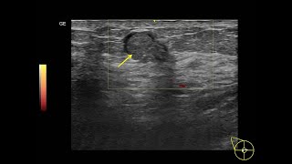 Intraductal papilloma Breast 유관내 유두종 유방 [upl. by Hpeseoj]