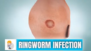 Ringworm  Types Symptoms and Treatment of Fungal infection of Skin [upl. by Aitret]