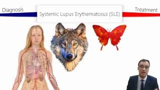 Systemic Lupus Erythematosus SLE [upl. by Browne]