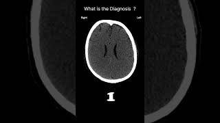 Hypoxic brain injury with cerebral oedema Acute CT Brain Brain volume 57 radiologychannel007 [upl. by Giark953]