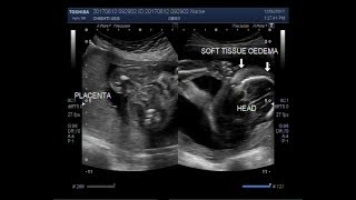 Ultrasound Video showing the fetal head small for dates ie Microcephaly [upl. by Einapets430]