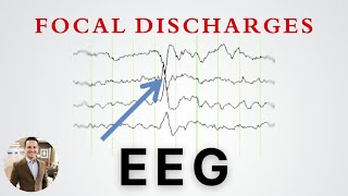 Focal Discharges on EEG and what they mean in Epilepsy [upl. by Glynnis]