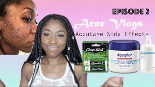 Skin  Side Effects of Accutane  The Purge Week 2  Shanese Danae [upl. by Aicineohp433]