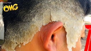 Itchy Psoriasis Scalp Removal At Home 191 [upl. by Desma]