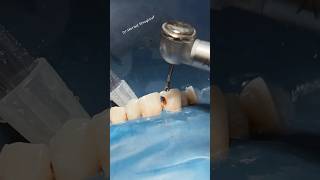 Cavity liner and composite restoration satisfying asmr [upl. by Anaitat]