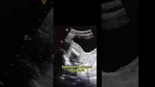 Endometrial osseous metaplasia in ultrasound [upl. by Eldrid]