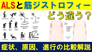 筋ジストロフィーと筋萎縮性側索硬化症（ALS）の違いを理解する  症状、原因、進行パターンの比較解説 [upl. by Sutsugua]