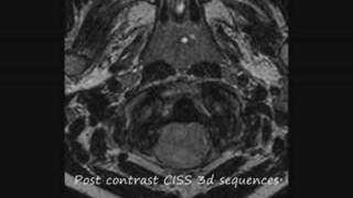 The plastic monster ependymoma how do you deal with this brain tumor in a six year old child [upl. by Rawna]