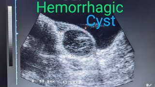 Ovary Hemorrhagic Cyst medicalimagingbyzubair ultrasound [upl. by Ramahs832]