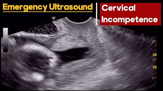 Cervical Incompetence  How to Diagnose  Abdominal vs TVS Ultrasound [upl. by Ardnu]