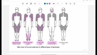 Myopathies part 3  Inherited myopathies  Harrison made easy [upl. by Lateh]