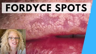 SYRINGOMA VS FORDYCE SPOTS  NATURAL REMEDIES [upl. by Alahs253]