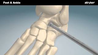 Stryker Foot and Ankle  SubFix™ Arthroeresis Implant Animation [upl. by Christoffer156]