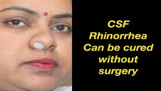 CSF Rhinorrhea case cured by Homeopathy Dr Ravi Singh [upl. by Enitselec]