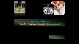 Ultrasound Case 84 Inguinal Cystocele Hernia mimic [upl. by Atiz]