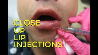 CLOSE UP LIP INJECTIONS [upl. by Airehs]