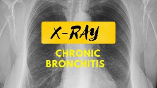 Things Found In An X Ray  Xray of Chest  Chronic Bronchitis  Right Ventricular Hypertrophy [upl. by Asfah]