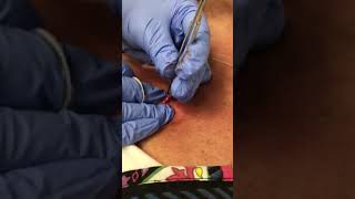 Rare Schwannoma Removal [upl. by Mungam844]