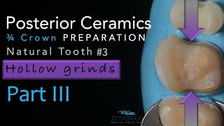 Zirconia Ceramics Part 3 ThreeQuarter Crown Preparation  Using Hollow Grind [upl. by Alage]