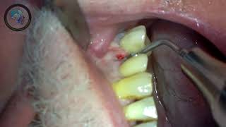 Atraumatic Piezotome tooth extraction amp implant insertion [upl. by Medovich]