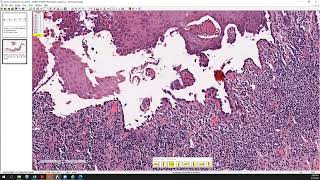 Pemphigus foliaceus and pemphigus vulgaris [upl. by Idak871]