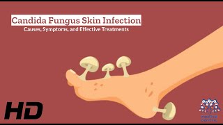 Candida Fungus Skin Infection Explained What You Need to Know [upl. by Ganley]