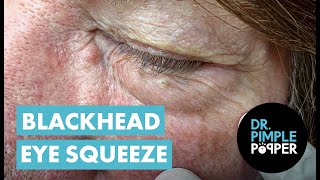 Blackhead Eye Squeeze [upl. by Anaeg]