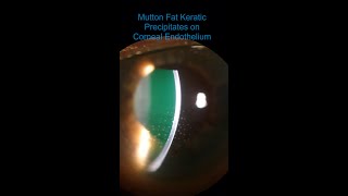 Intermediate Uveitis  Vitritis amp Mutton Fat KPs [upl. by Suoirrad]