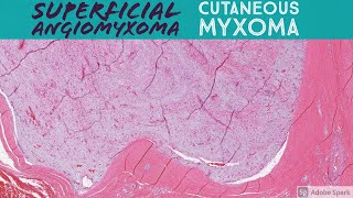 Cutaneous Myxoma aka Superficial Angiomyxoma [upl. by Ameyn]